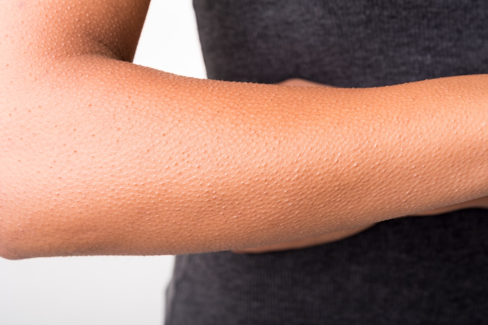 Close up of goosebumps on the skin